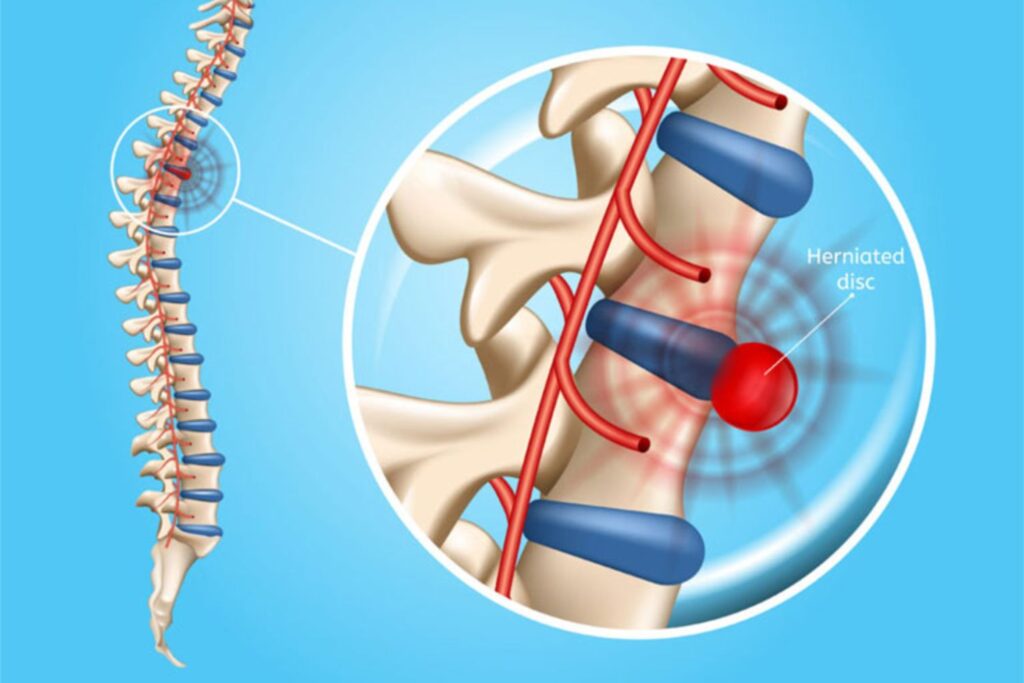 chứng thoát vị đĩa đệm